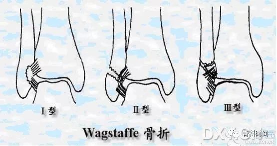 这些骨折据说 99% 的医生都没见过