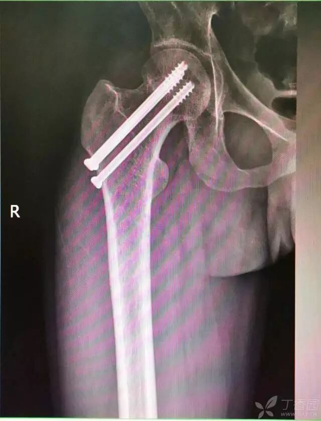 牵引床怎么用视频详解：如何不使用牵引床做好一台股骨颈骨折？_https://www.jmylbn.com_新闻资讯_第25张