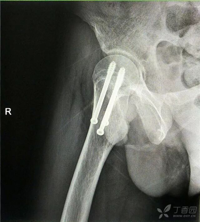 牵引床怎么用视频详解：如何不使用牵引床做好一台股骨颈骨折？_https://www.jmylbn.com_新闻资讯_第23张