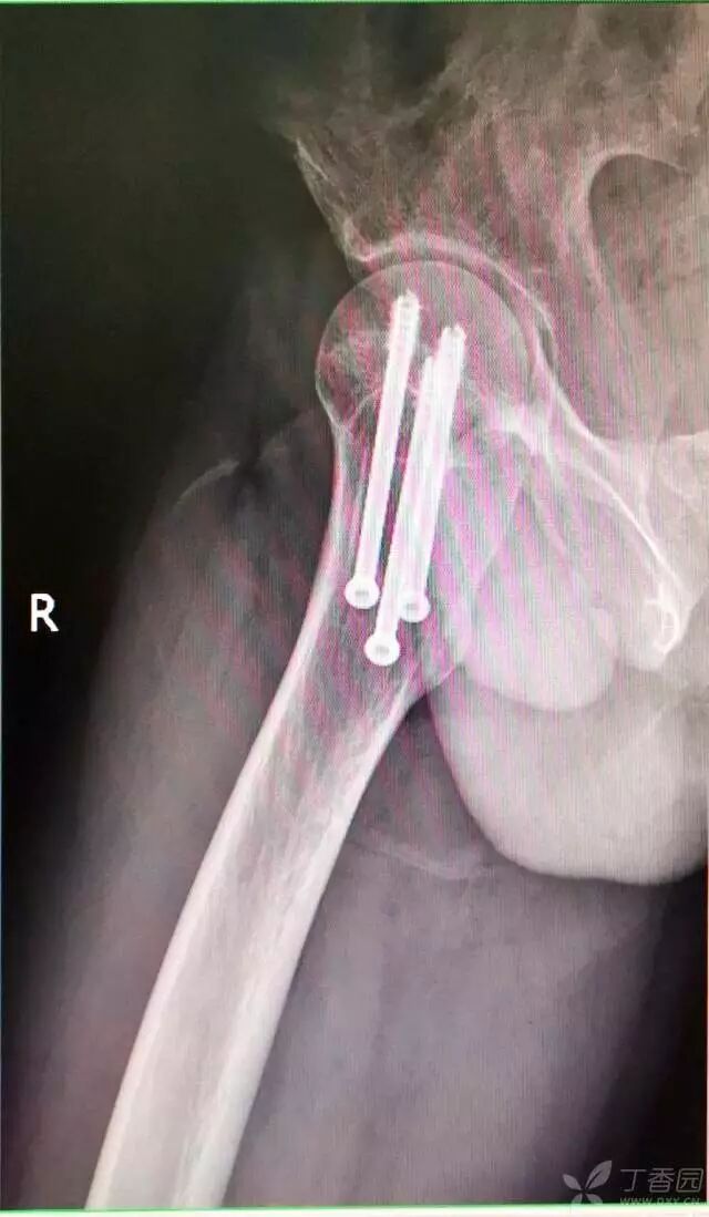 牵引床怎么用视频详解：如何不使用牵引床做好一台股骨颈骨折？_https://www.jmylbn.com_新闻资讯_第26张