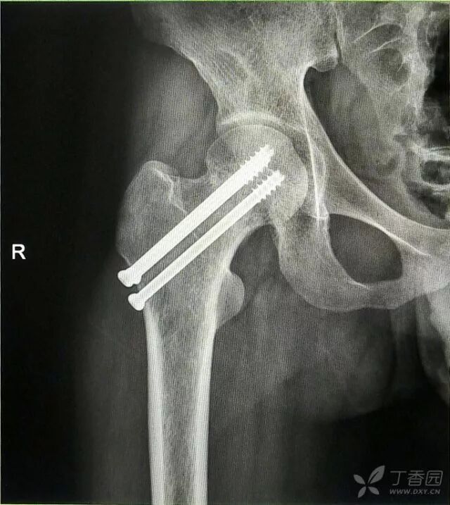 牵引床怎么用视频详解：如何不使用牵引床做好一台股骨颈骨折？_https://www.jmylbn.com_新闻资讯_第22张