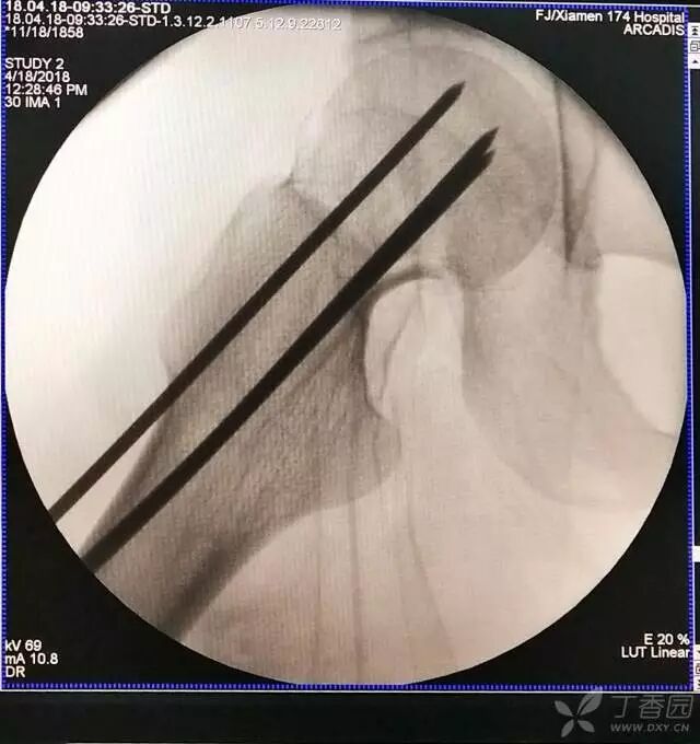 牵引床怎么用视频详解：如何不使用牵引床做好一台股骨颈骨折？_https://www.jmylbn.com_新闻资讯_第16张