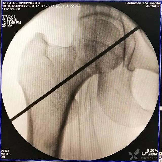 牵引床怎么用视频详解：如何不使用牵引床做好一台股骨颈骨折？_https://www.jmylbn.com_新闻资讯_第12张