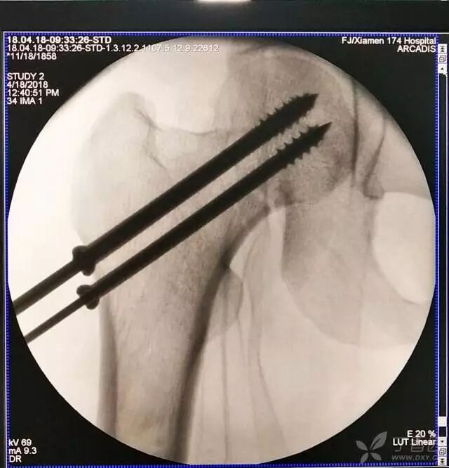 牵引床怎么用视频详解：如何不使用牵引床做好一台股骨颈骨折？_https://www.jmylbn.com_新闻资讯_第17张