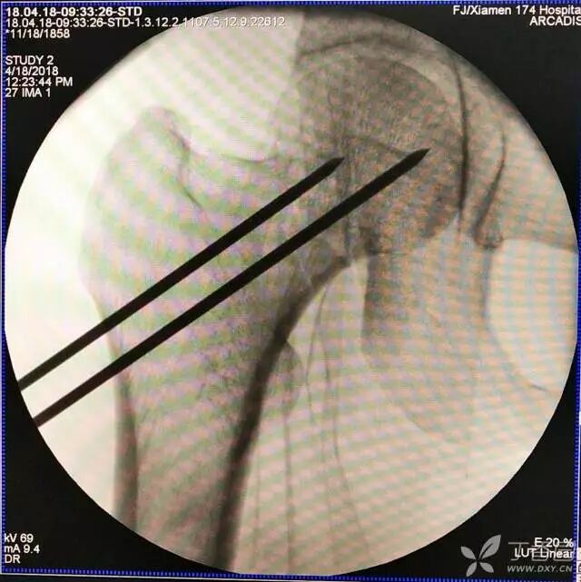 牵引床怎么用视频详解：如何不使用牵引床做好一台股骨颈骨折？_https://www.jmylbn.com_新闻资讯_第21张
