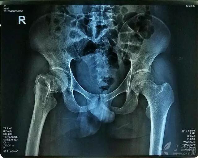 牵引床怎么用视频详解：如何不使用牵引床做好一台股骨颈骨折？_https://www.jmylbn.com_新闻资讯_第3张