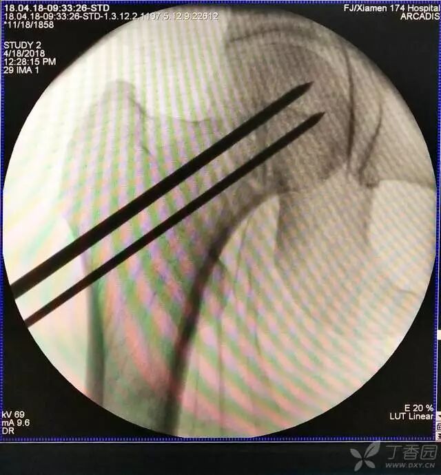 牵引床怎么用视频详解：如何不使用牵引床做好一台股骨颈骨折？_https://www.jmylbn.com_新闻资讯_第15张
