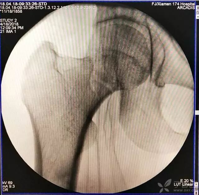 牵引床怎么用视频详解：如何不使用牵引床做好一台股骨颈骨折？_https://www.jmylbn.com_新闻资讯_第11张
