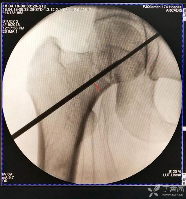 牵引床怎么用视频详解：如何不使用牵引床做好一台股骨颈骨折？_https://www.jmylbn.com_新闻资讯_第19张