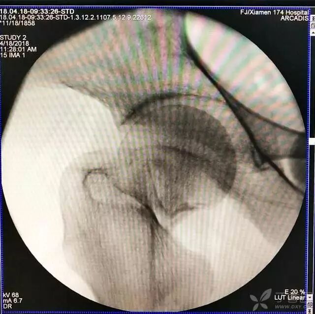 牵引床怎么用视频详解：如何不使用牵引床做好一台股骨颈骨折？_https://www.jmylbn.com_新闻资讯_第2张