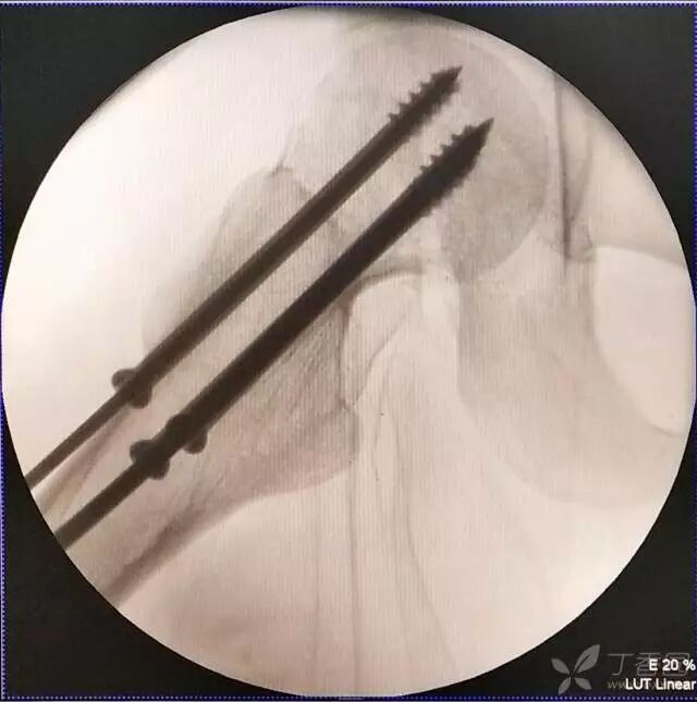 牵引床怎么用视频详解：如何不使用牵引床做好一台股骨颈骨折？_https://www.jmylbn.com_新闻资讯_第18张