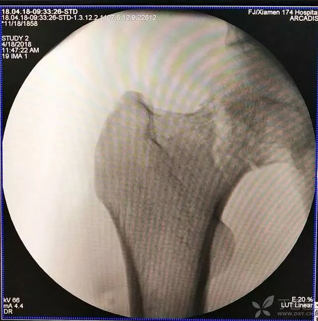 牵引床怎么用视频详解：如何不使用牵引床做好一台股骨颈骨折？_https://www.jmylbn.com_新闻资讯_第10张