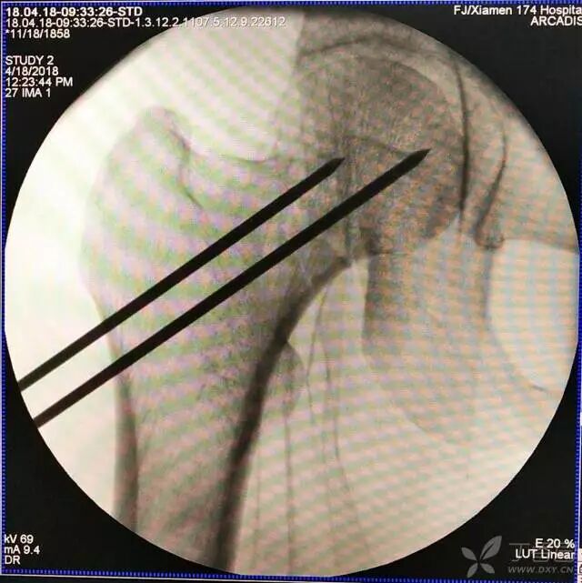 牵引床怎么用视频详解：如何不使用牵引床做好一台股骨颈骨折？_https://www.jmylbn.com_新闻资讯_第14张