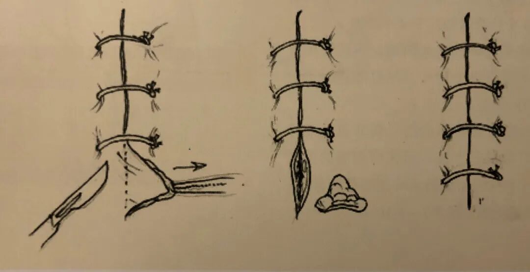 医疗缝线怎么做骨科精读 ｜ 如何做好手术缝合？这8种技术助你一臂之力！_https://www.jmylbn.com_新闻资讯_第11张