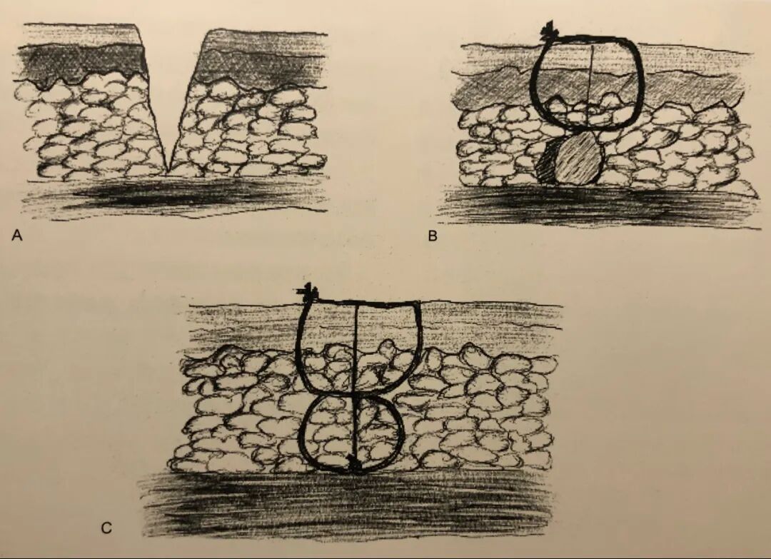 医疗缝线怎么做骨科精读 ｜ 如何做好手术缝合？这8种技术助你一臂之力！_https://www.jmylbn.com_新闻资讯_第9张