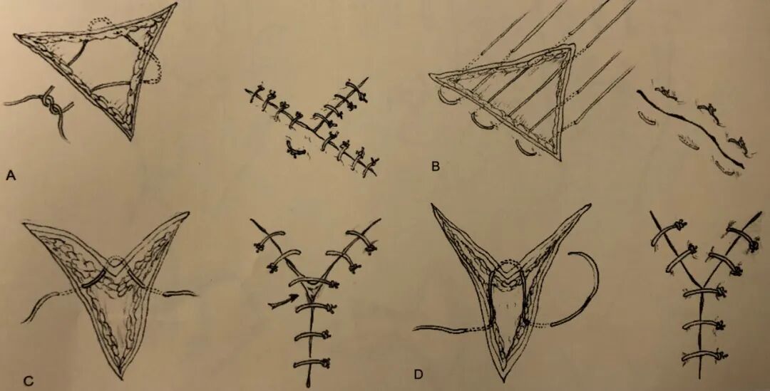 医疗缝线怎么做骨科精读 ｜ 如何做好手术缝合？这8种技术助你一臂之力！_https://www.jmylbn.com_新闻资讯_第12张