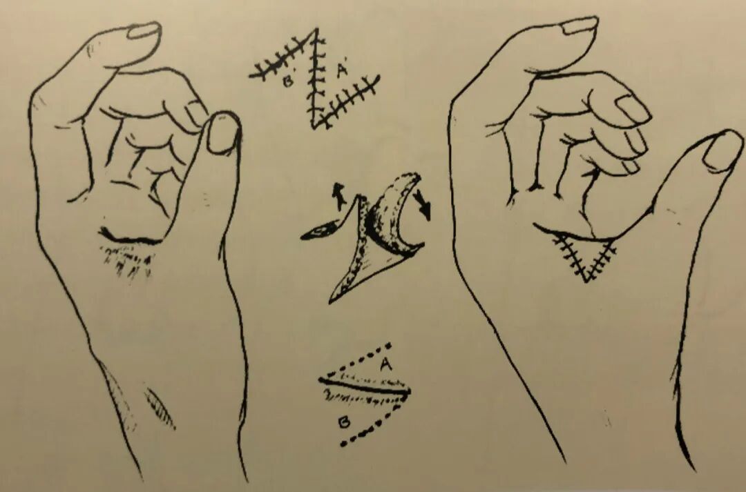 医疗缝线怎么做骨科精读 ｜ 如何做好手术缝合？这8种技术助你一臂之力！_https://www.jmylbn.com_新闻资讯_第16张