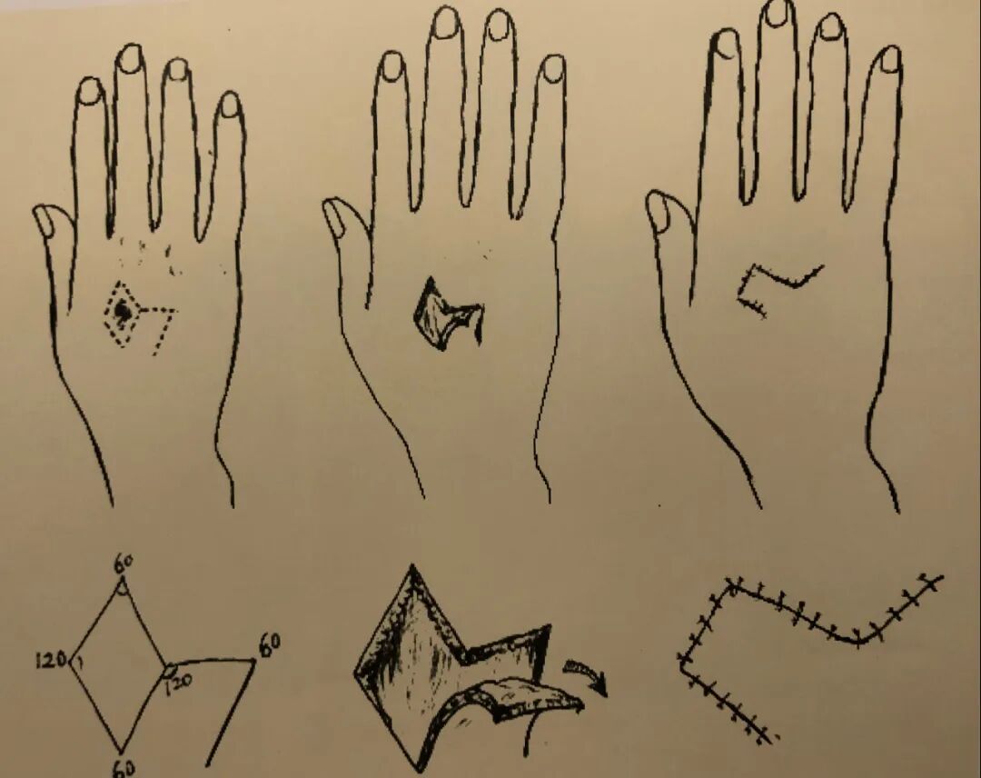 医疗缝线怎么做骨科精读 ｜ 如何做好手术缝合？这8种技术助你一臂之力！_https://www.jmylbn.com_新闻资讯_第13张