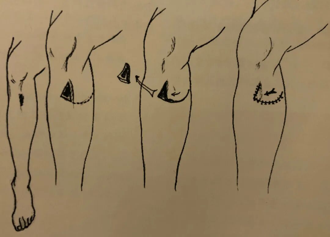 医疗缝线怎么做骨科精读 ｜ 如何做好手术缝合？这8种技术助你一臂之力！_https://www.jmylbn.com_新闻资讯_第15张