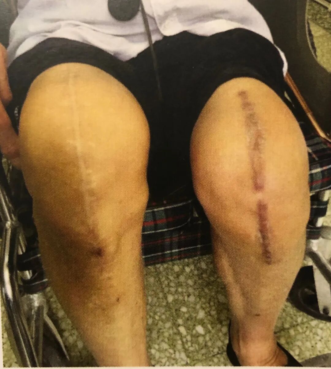 医疗缝线怎么做骨科精读 ｜ 如何做好手术缝合？这8种技术助你一臂之力！_https://www.jmylbn.com_新闻资讯_第8张