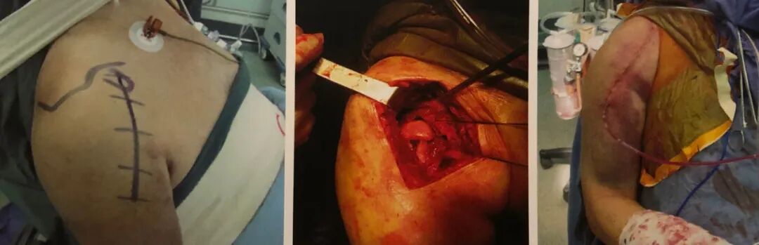 医疗缝线怎么做骨科精读 ｜ 如何做好手术缝合？这8种技术助你一臂之力！_https://www.jmylbn.com_新闻资讯_第10张