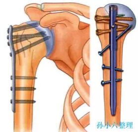 医疗康复包括什么骨质疏松性骨折：诊断、治疗和康复一文整理！_https://www.jmylbn.com_新闻资讯_第32张