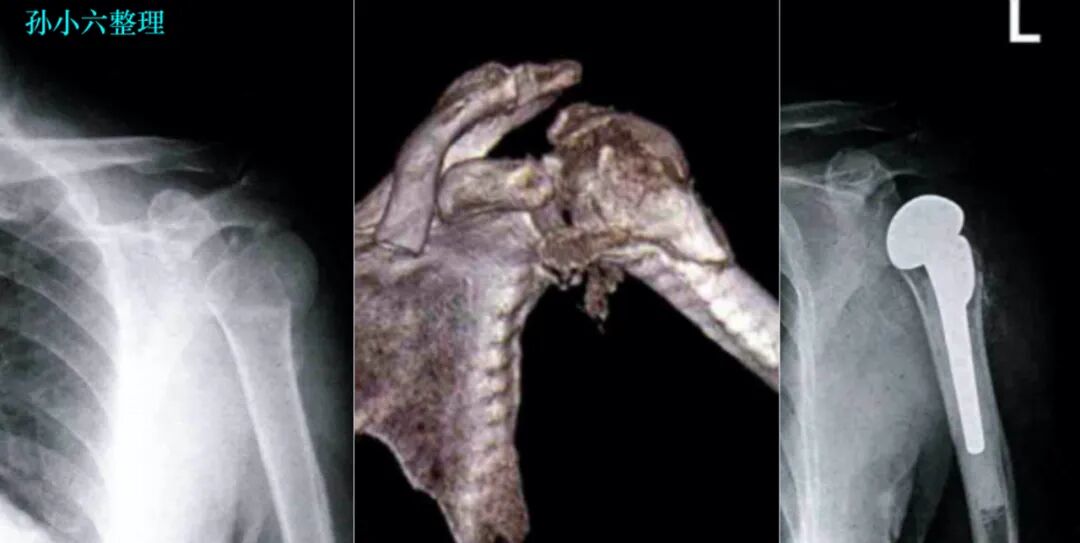 医疗康复包括什么骨质疏松性骨折：诊断、治疗和康复一文整理！_https://www.jmylbn.com_新闻资讯_第33张