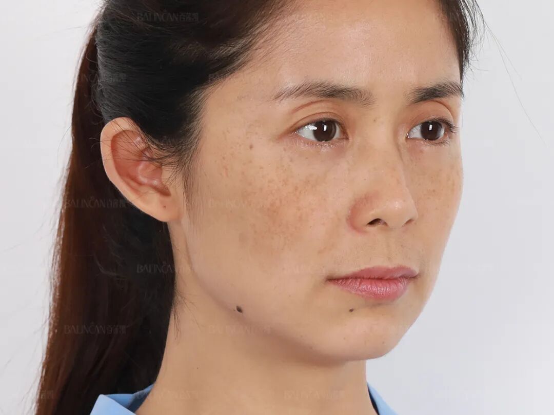 长色斑千万别乱治皮肤科医生这个建议50岁前都有救