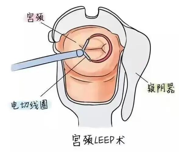 妇科leep刀怎么用【妇科科普】LEEP刀——让女人远离宫颈疾病_https://www.jmylbn.com_新闻资讯_第3张