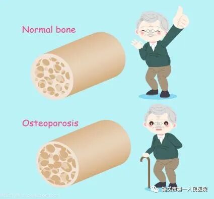 双能x骨密度检测仪为什么非得输入体重身高GE双能X线骨密度仪：检测骨质疏松的好助手_https://www.jmylbn.com_新闻资讯_第2张
