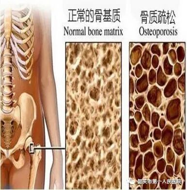 双能x骨密度检测仪为什么非得输入体重身高GE双能X线骨密度仪：检测骨质疏松的好助手_https://www.jmylbn.com_新闻资讯_第3张