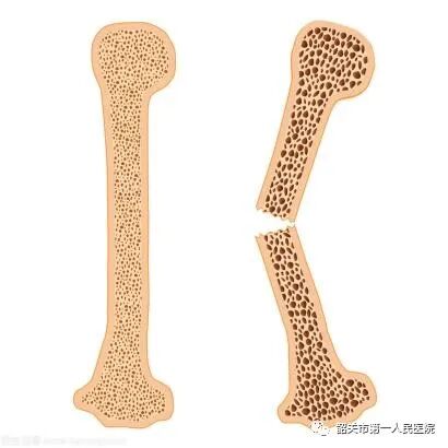 双能x骨密度检测仪为什么非得输入体重身高GE双能X线骨密度仪：检测骨质疏松的好助手_https://www.jmylbn.com_新闻资讯_第4张