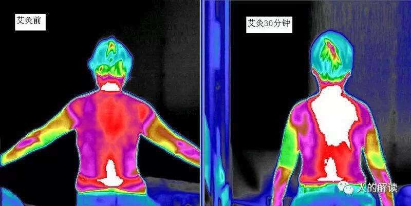 神奇的艾灸，为何无艾不成灸？-人的解读