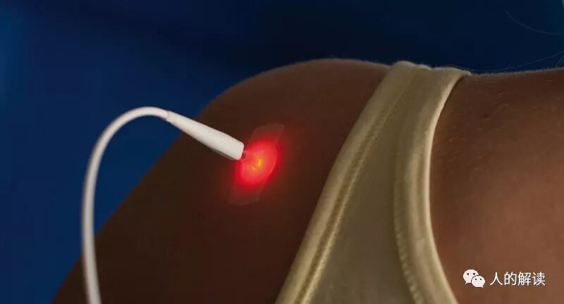激光针灸：古老经络与现代科技的完美结合-人的解读