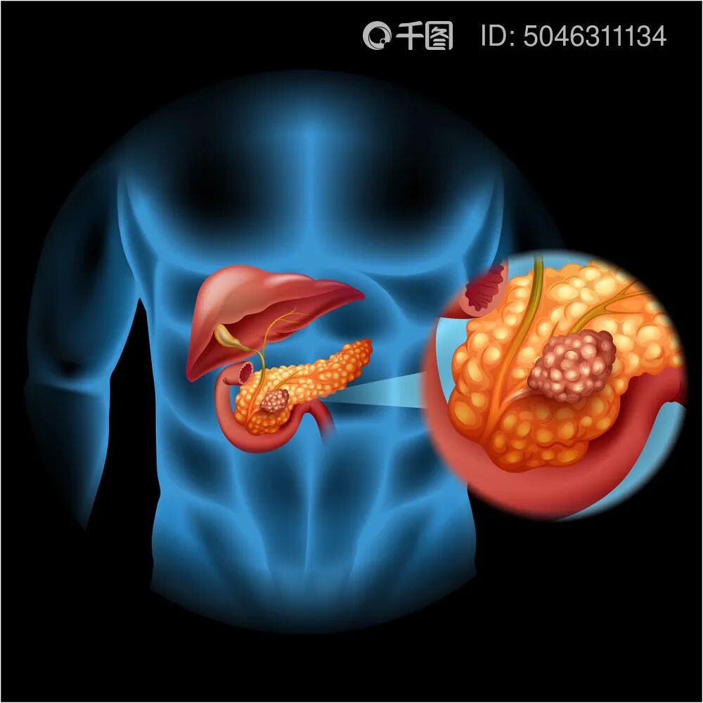 胰腺癌为什么称为“万癌之王”？