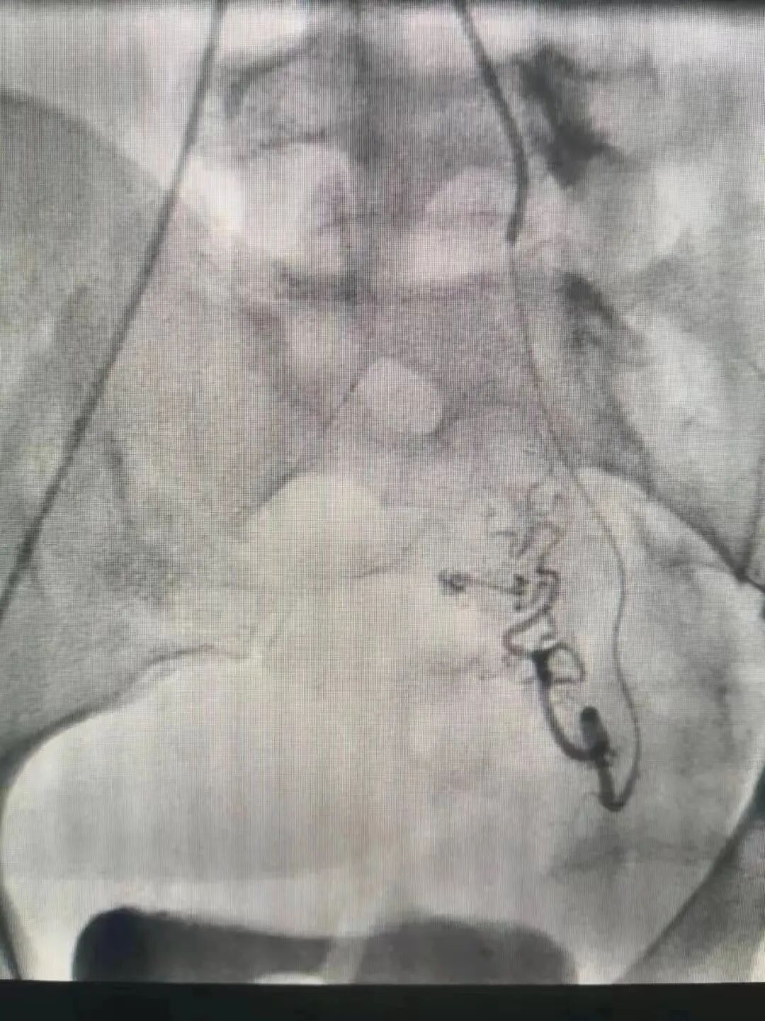 什么是血管机神器落地 ｜ 我院引进GE Optima IGS 330数字减影血管造影机_https://www.jmylbn.com_新闻资讯_第8张