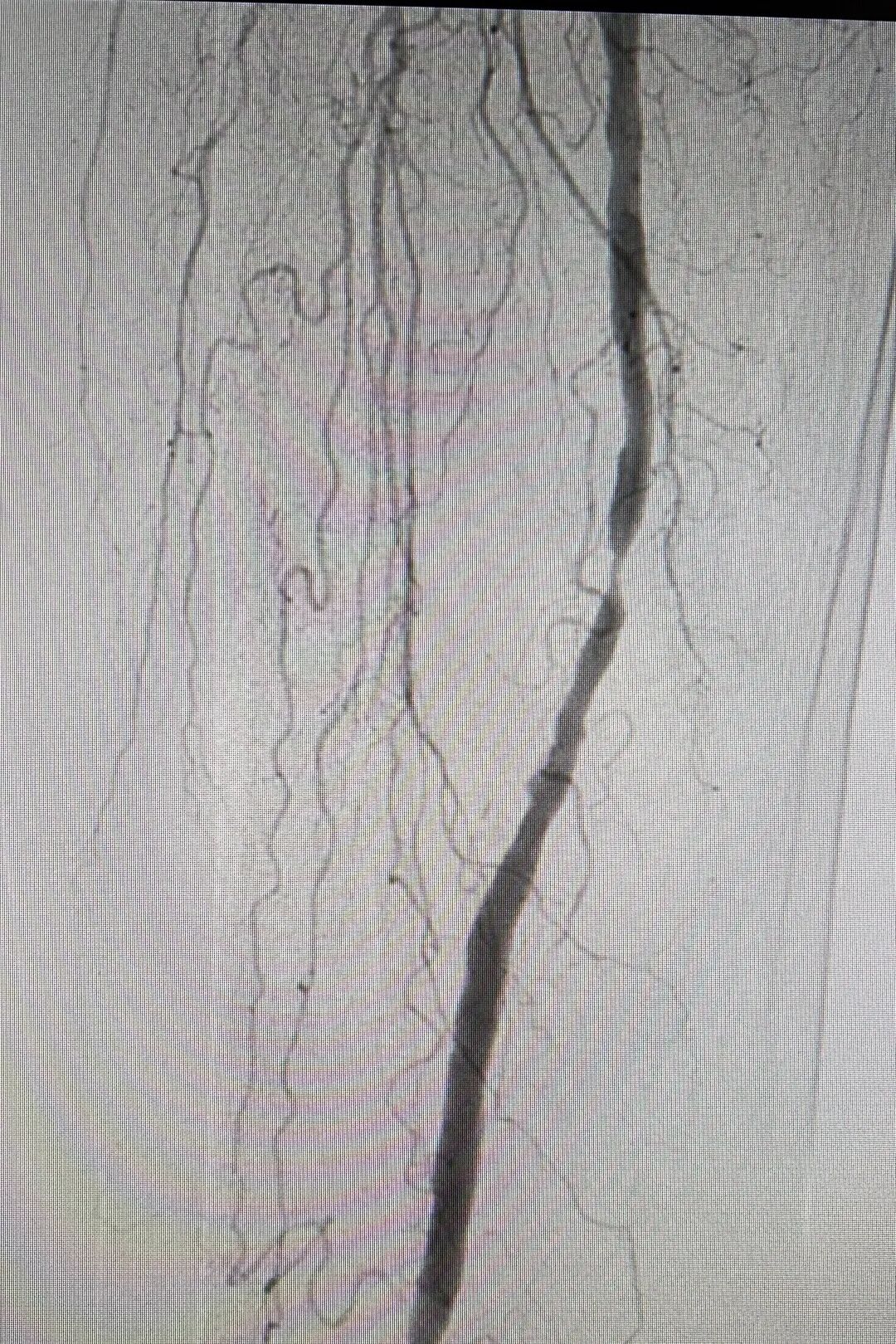 什么是血管机神器落地 ｜ 我院引进GE Optima IGS 330数字减影血管造影机_https://www.jmylbn.com_新闻资讯_第7张