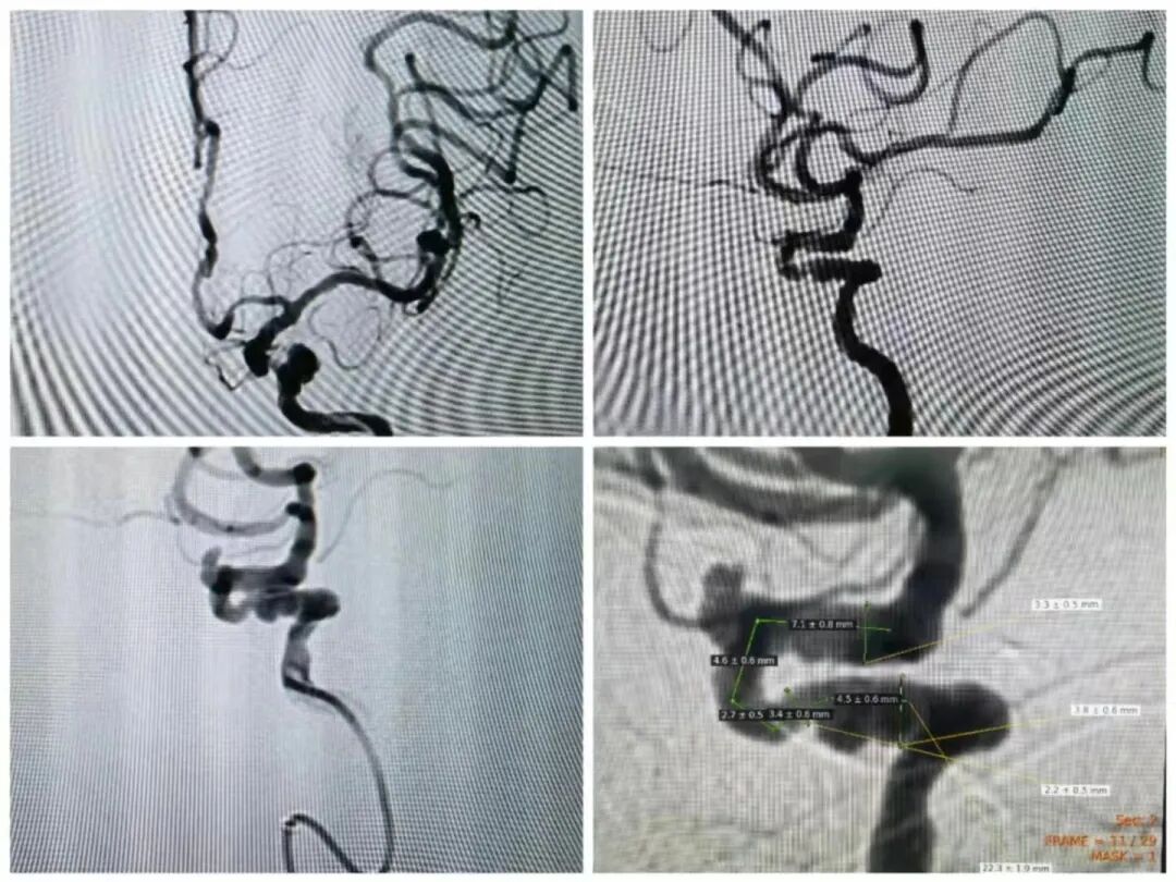 什么是血管机神器落地 ｜ 我院引进GE Optima IGS 330数字减影血管造影机_https://www.jmylbn.com_新闻资讯_第4张
