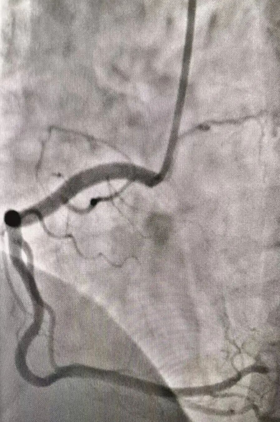 什么是血管机神器落地 ｜ 我院引进GE Optima IGS 330数字减影血管造影机_https://www.jmylbn.com_新闻资讯_第6张
