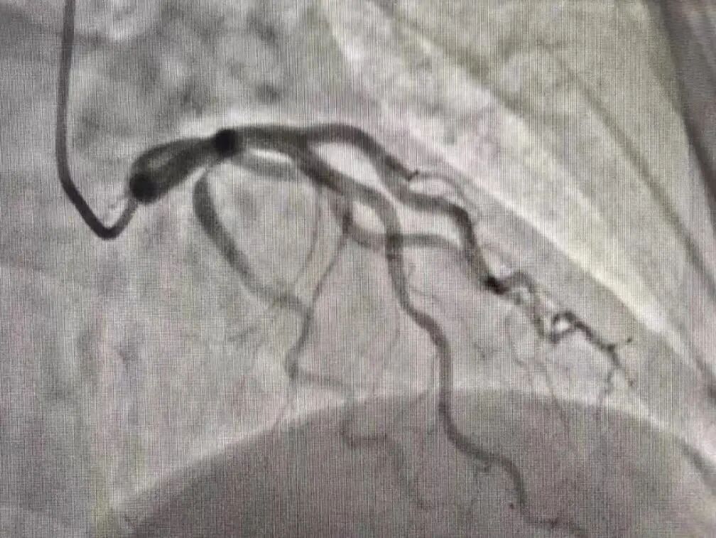 什么是血管机神器落地 ｜ 我院引进GE Optima IGS 330数字减影血管造影机_https://www.jmylbn.com_新闻资讯_第5张