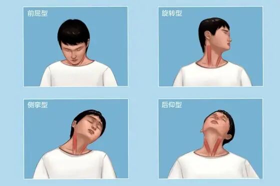 d-spect怎么检查【科普周刊245期】“歪脖子病”怎么办，核医学99mTc-MIBI SPECT／CT检查来助力_https://www.jmylbn.com_新闻资讯_第2张
