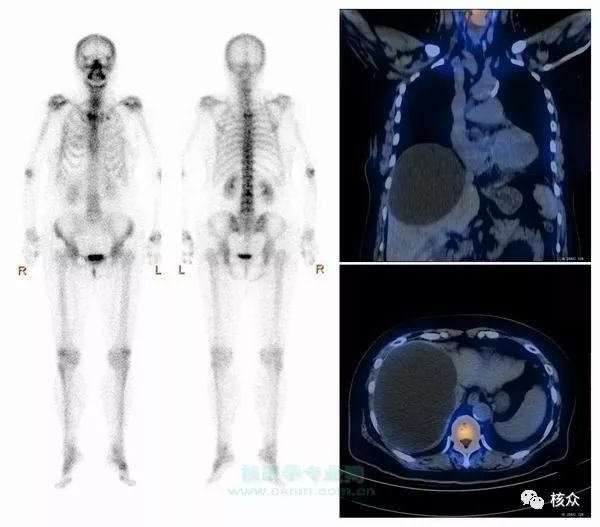 医生 我的骨扫描怎么缺了一大片骨头 核众 微信公众号文章阅读 Wemp