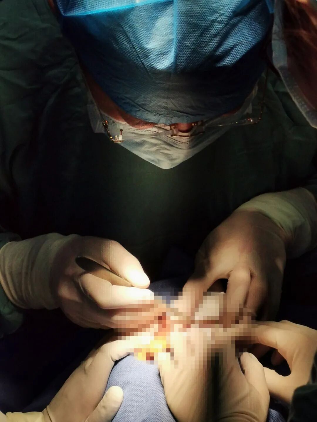 为什么要用皮肤吻合器手术后终于不用缝针啦！皮肤“拉链”，一拉就好，不留疤_https://www.jmylbn.com_新闻资讯_第18张