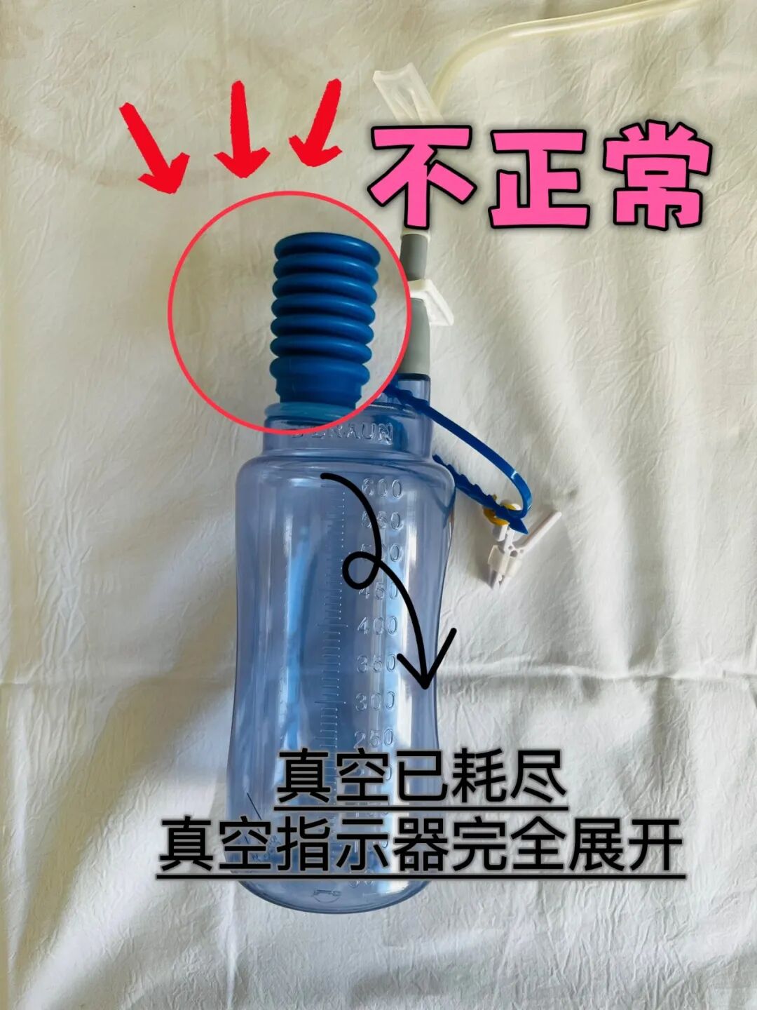 为什么负压可以引流管《 新华科普 · 乳腺健康 》第20篇  ｜ 【答疑解惑 】 术后伤口最佳护理方式在这里！_https://www.jmylbn.com_新闻资讯_第14张