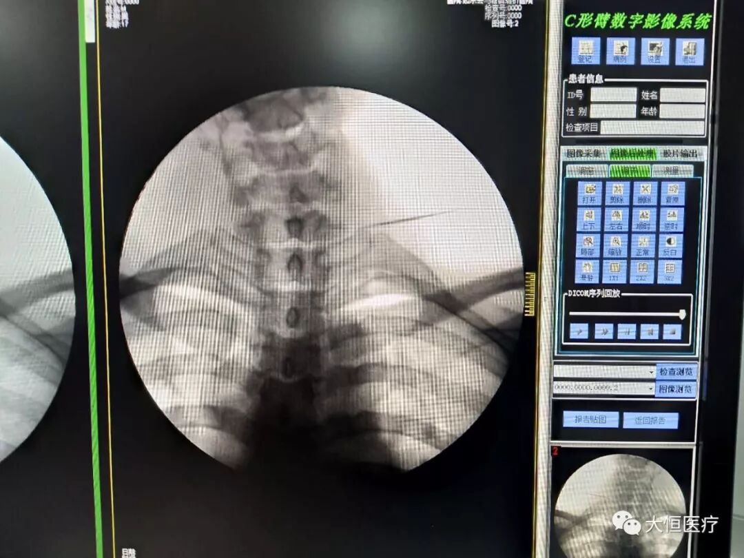 c臂怎么启动全智能型疼痛科／介入型C型臂_https://www.jmylbn.com_新闻资讯_第2张