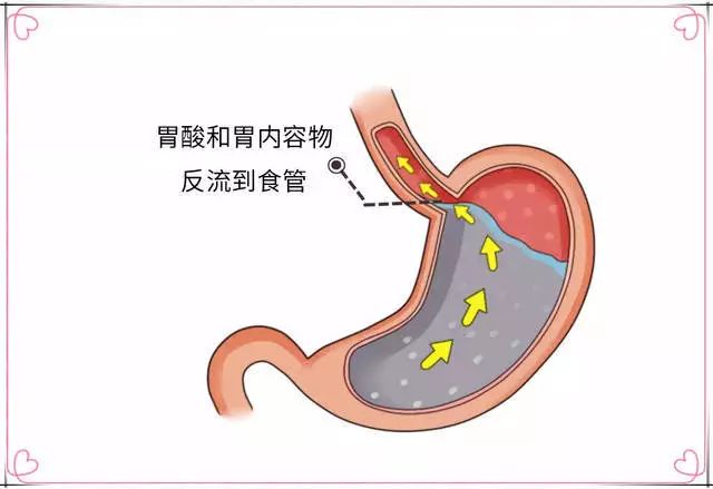 反酸,燒心,打嗝是