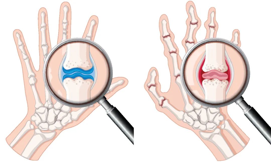 风湿性关节炎，如何用药？