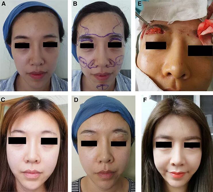 局麻时面部脂肪移植疗效及安全性评估