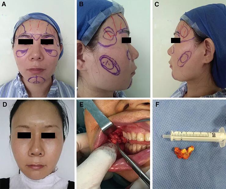 局麻时面部脂肪移植疗效及安全性评估