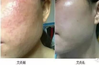 面部灸一灸，年轻10来岁！太棒了~|养生知识-南阳宛艾产业协会